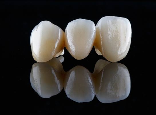 Close-up of dental bridge in Hanover on black reflective surface