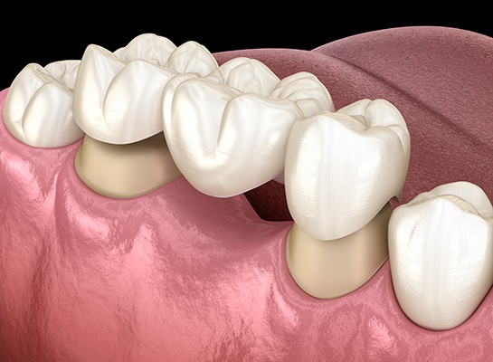 Illustration of dental bridge being placed on prepared teeth in lower arch