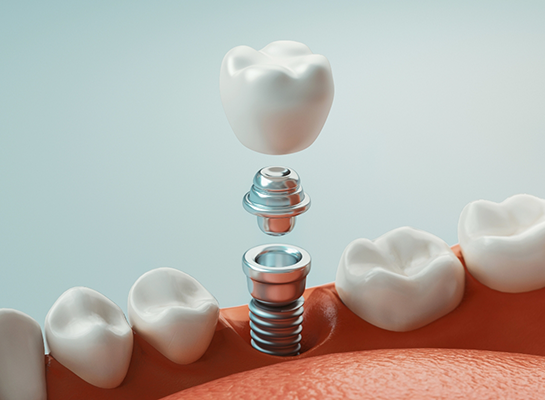 Illustration of dental implant with crown replacing a missing lower tooth