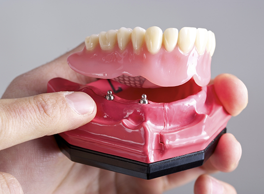 Hand holding a model of an implant denture