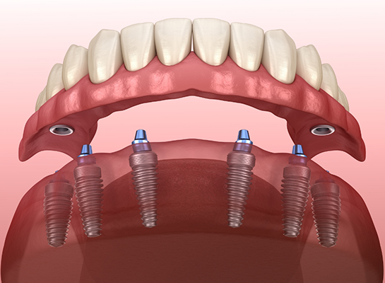 Illustrated full denture supported by six dental implants