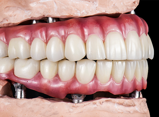 Model of hybrid overdentures