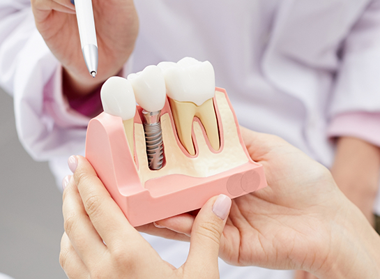 Dentist showing a dental implant model to a patient