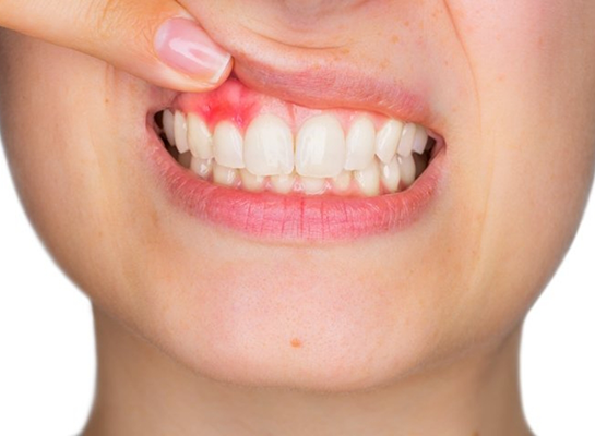 Close up of person pointing to red spot in their gums