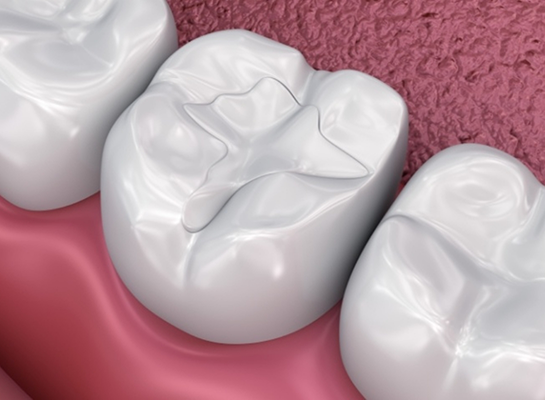 Illustrated teeth with dental sealants