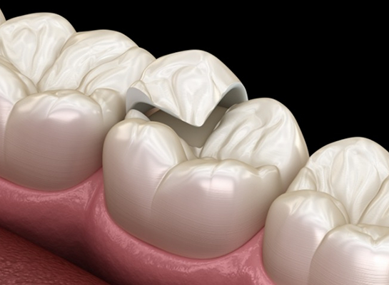 Illustrated onlay being placed on a broken tooth