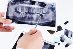 a dental professional points at an xray and explains to a patient about the full mouth reconstruction cost for them