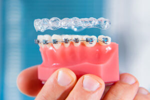 a person holds a model of teeth wearing braces next to invisalign as they explain the differences of invisalign vs braces
